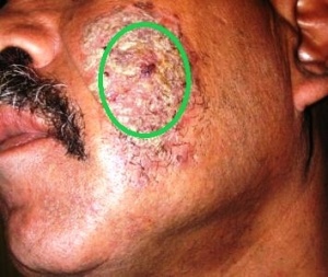 blue waffle disease on face in men 