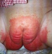 Fungal Diaper rash