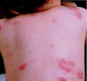 fungal rash on back