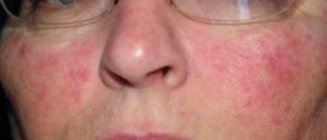 fungal rash on face