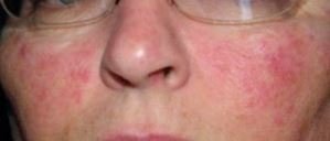 Facial Fungal Rash 72