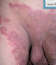 Fungal rash on groin