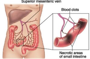 mesenteric ischemia