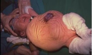 prune belly syndrome image