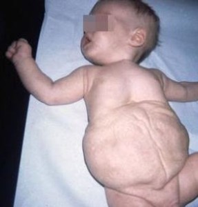 prune belly syndrome photo