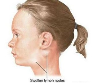 swollen lymph nodes