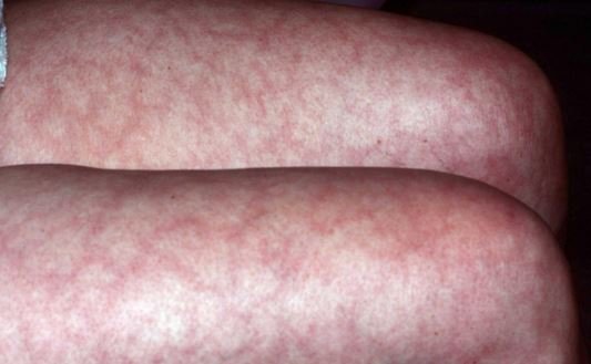 livedo-reticularis-causes-pictures-treatment-symptoms