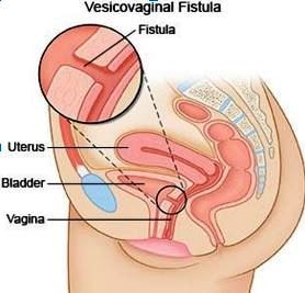 Vesicovaginal Fistula image