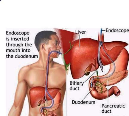 bile duct cancer photo
