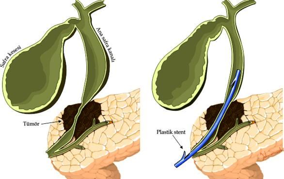 bile duct cancer