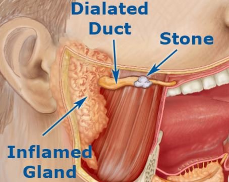 blocked salivary glands stone inflamed duct