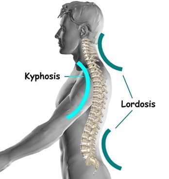 lumbar lordosis image