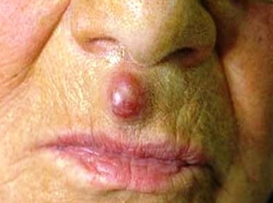 merkel cell carcinoma on upper lip