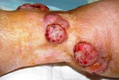 merkel cell carcinoma over foot