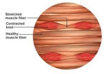 muscle knots muscles