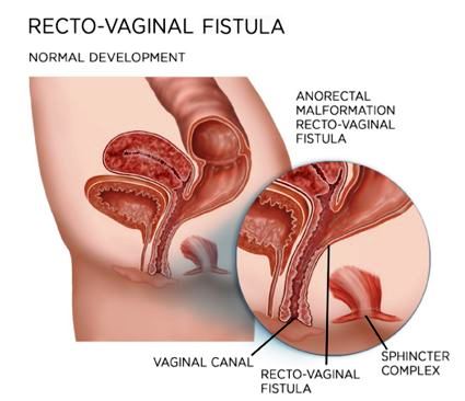 rectovaginal fistula image
