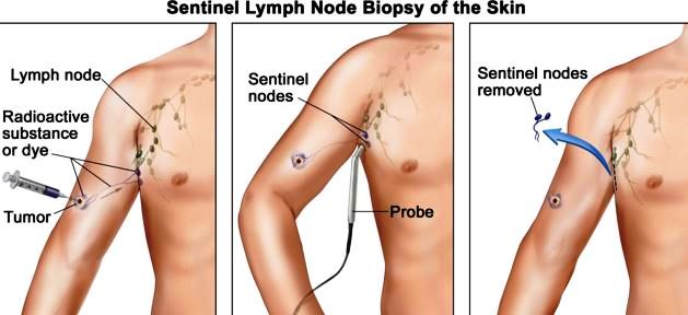 sentinel lymph node biopsy merkel cell carcinoma