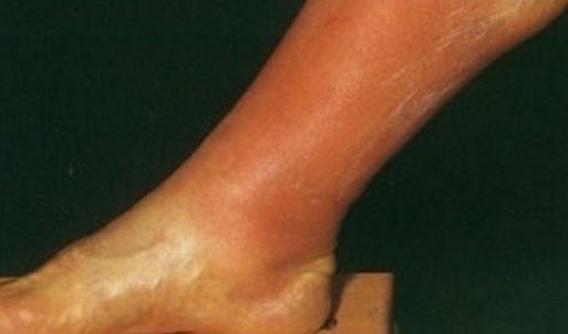 superficial thrombophlebitis picture