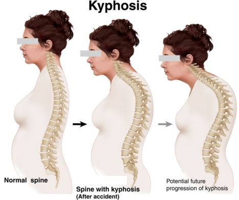 thoraxic kyphosis progression