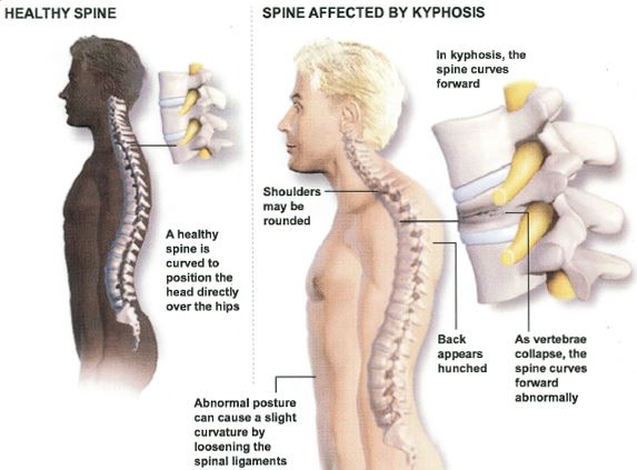 Thoracic Kyphosis symptoms signs