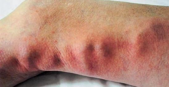 thrombophlebitis picture