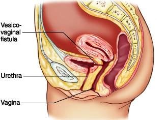 vaginal fistula location