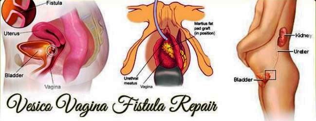 vesicovaginal fistula repair