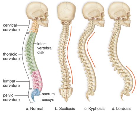 abnormal curvature of the spine