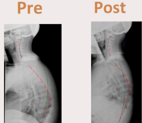 cervical lordosis pre and post treatment