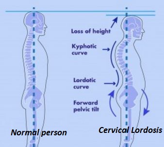cervical lordosis symptoms