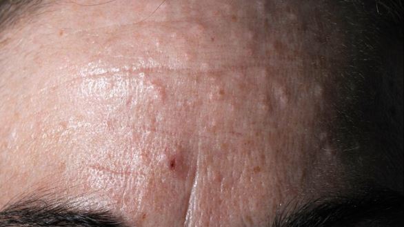 sebaceous hyperplasia on frontum picture