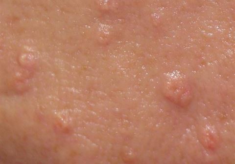 sebaceous hyperplasia pictures 2