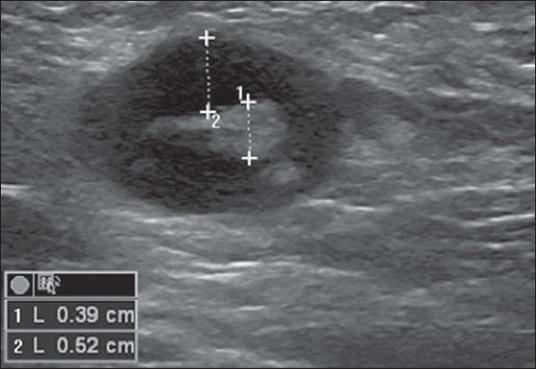 enlarged axillary lymph nodes in CT scan