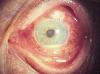  Person’s eye with iridocyclitis