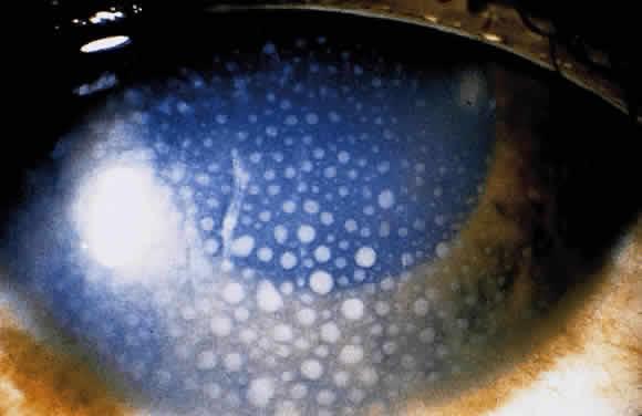 Keratic precipitates of an eye with iridocyclitis