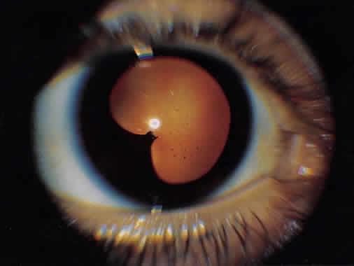Right eye of patient with uveitis showing localized area of posterior synechiae