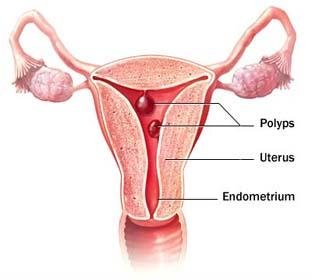 Menometrorrhagia Polypus in the fundus of the uterus that could be the reason for bleeding 