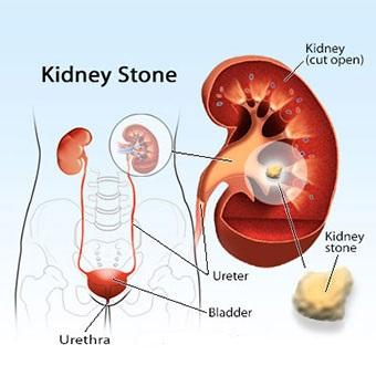 Cloudy Urine kidney stone