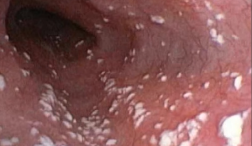 Vaginal infection caused by Candidiasis around the vagina