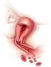 Menometrorrhagia Bleeding from the uterus (2)