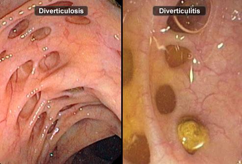 Diverticulitis Surgery