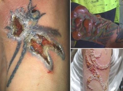 Infected Tattoo Photos