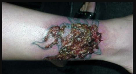 Infected Tattoo on leg