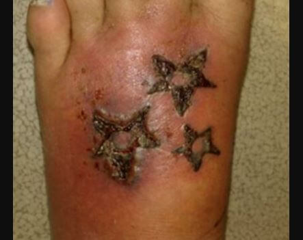 Infected tattoo on foot