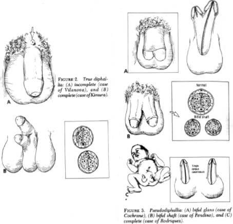 Diphallia Anatomy