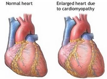 postpartum cardiomyopathy