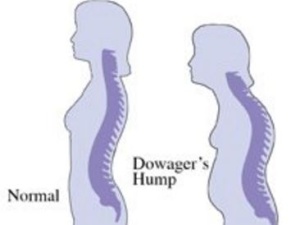 Dowager’s Hump - Exercises, Pictures, Treatment, Causes