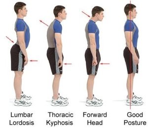 Lumbar Lordosis - Exercises, How to Fix, Treatment, What is