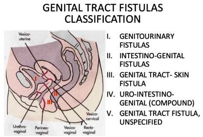 vaginal fistula