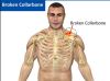 Collarbone Pain Location